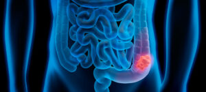 Cancer du côlon : un programme d’exercice structuré de 3 ans réduit de 28 % le risque de récidive (essai CHALLENGE – NEJM 2025)